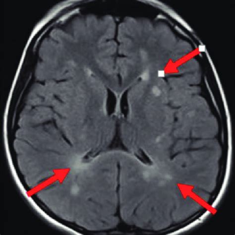 Periventricular and subcortical white matter hyperintensities in T2W ...