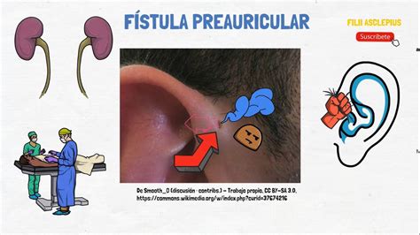 FÍstula Preauricular Youtube