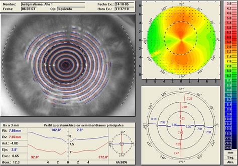 topografia corneal Optica Trinidad Málaga