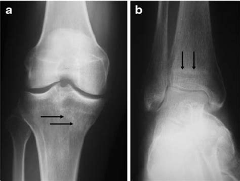 Femoral Condyle Insufficiency Fracture