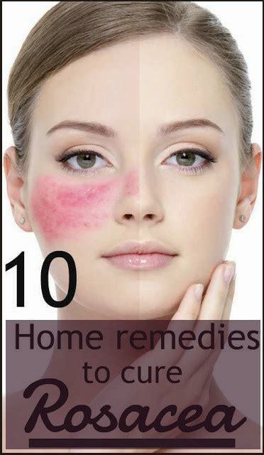 10 Best Home Remedies To Cure Rosacea Beauty4everything3