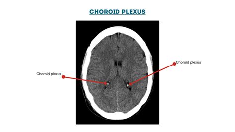 CT Head Interpretation | Radiology | Geeky Medics