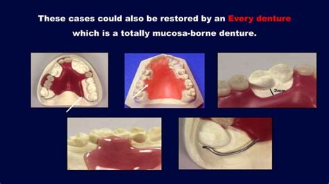 2 B Basic Principles For Designing Kennedy Class Ii Iii And Iv Removable Partial Denturerpd