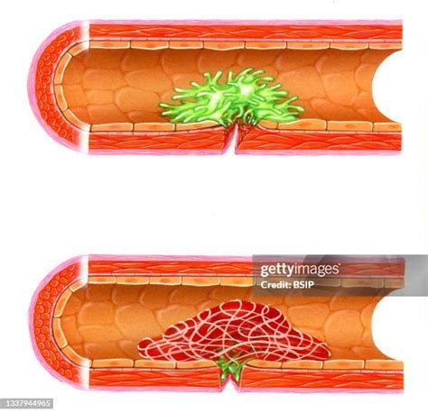 35 Coagulation Process Stock Photos, High-Res Pictures, and Images ...