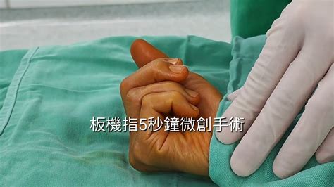 板機指 5秒鐘 無縫合 微創手術 Percutaneous Trigger Finger Release（聖功醫院） Youtube