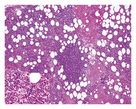 Case 1 Splenic Marginal Zone Lymphoma And Staging Bone Marrow Biopsy