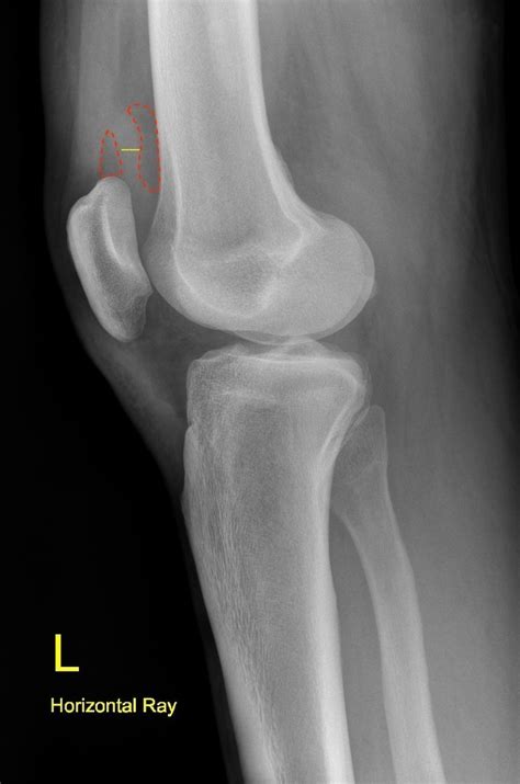 Knee joint effusion | Radiology Case | Radiopaedia.org