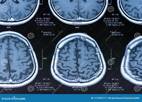 Brain ct scan stock image. Image of neurology, analyzing - 177296171