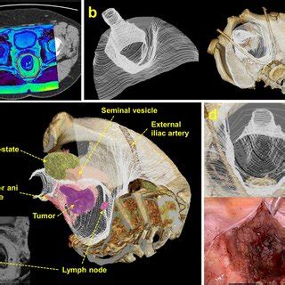 Definition And Calculation Of The Total Mesorectal Excision Tme