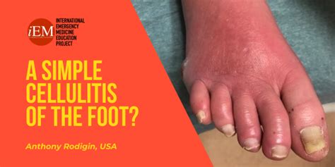 A Simple Cellulitis Of The Foot International Emergency Medicine Education Project