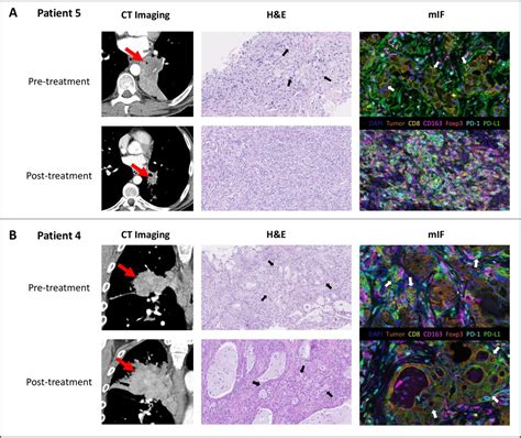 Neoadjuvant Nivolumab Plus Ipilimumab In Resectable Non Small Cell Lung Cancer Journal For