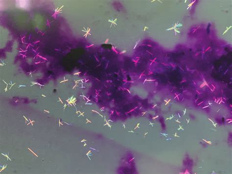 Synovial Fluid Showing Needle Shaped Monosodium Urate Crystals