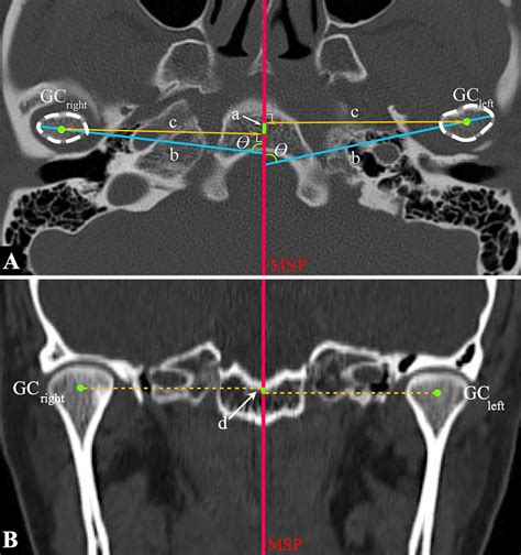 Positional Assessments Of The Condylar A Measurements Of The Download Scientific Diagram