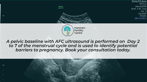 Services: Nuchal Translucency Ultrasound - Markham Fertility Centre