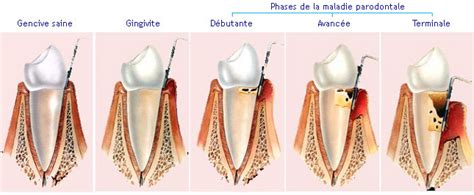 Maladie Parodontale Le Traitement
