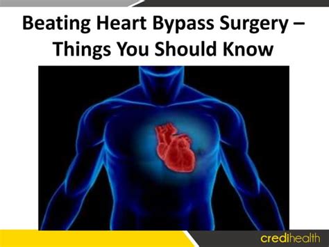 Beating Heart Bypass Surgery Things You Should Know Ppt