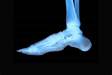 Ankle Fracture X Ray Stock Photos, Pictures & Royalty-Free Images - iStock