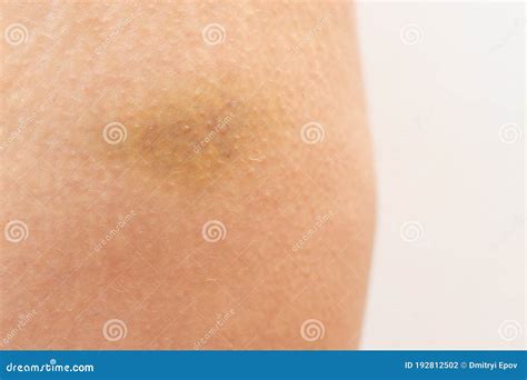 Yellow Bruise On The Skin Of The Thigh Woman`s Leg Injury Stock Photo