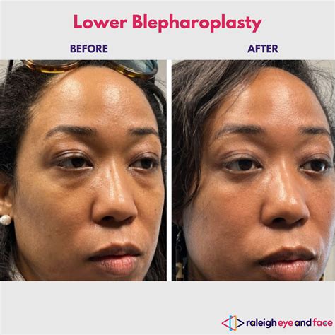 Lower Eyelid Blepharoplasty Raleigh Bilateral Eyelid Surgery Research Triangle — Raleigh Eye