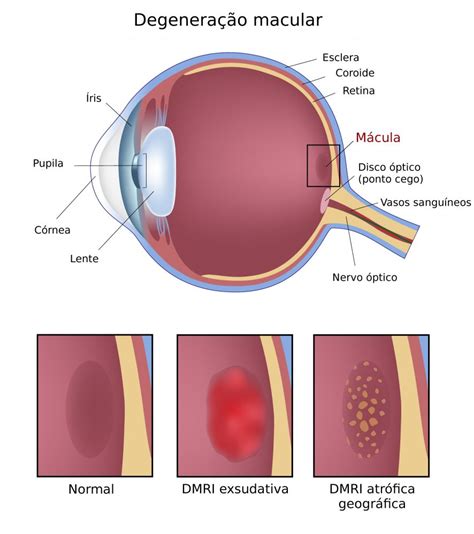 Professora Evelyn Degeneração macular