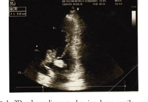 Figure 1 from Native Valve Streptococcus bovis Endocarditis and ...