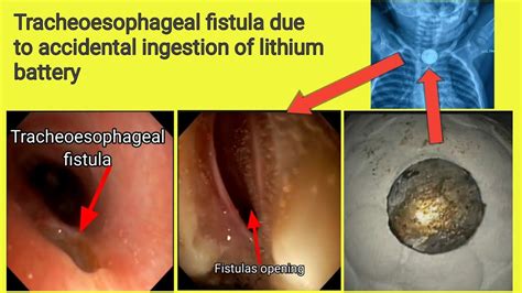 Tracheoesophageal Fistula Bd Endoscopy Youtube