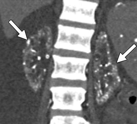 Diagnostic Approach To Benign And Malignant Calcifications In The