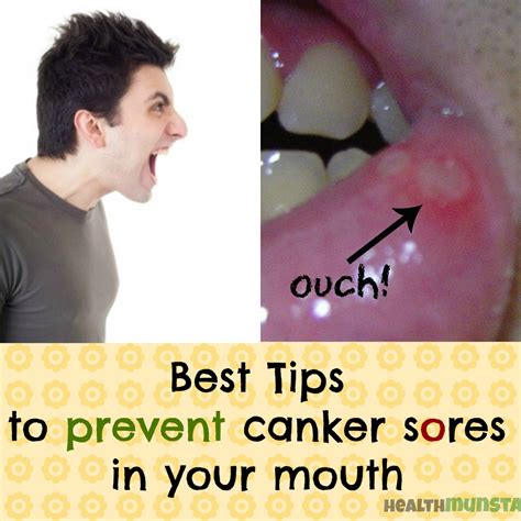 Pain Relief For Canker Sores And Mouth Ulcers Natural And Over The Counter Remedies Hubpages