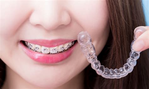 Can I Switch From Braces To Invisalign West House Dental