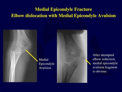 Fractures And Dislocations About The Elbow In The Pediatric Patient