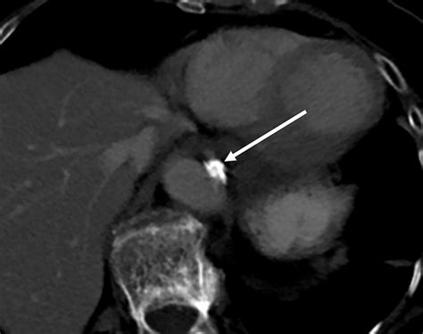 Orbital Atherectomy In Severely Calcified Visceral Artery Lesions