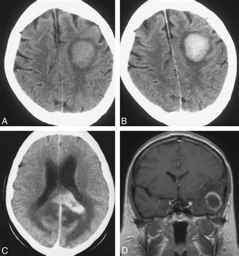 Lymphoma Brain Mri Hot Sex Picture