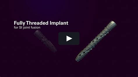 Journal Of Biocommunication Ifuse Torq Implant System On Vimeo