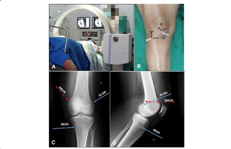 Anatomical Targets For Fluoroscopic Guided Genicular Nerve Blockade A