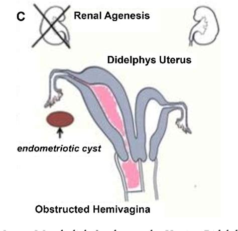 Figure 1 From Uterine Didelphys In A Pregnant Mother Semantic Scholar