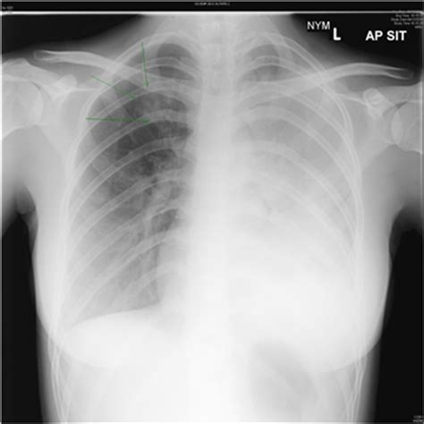 Mycoplasma Pneumoniae, an Important Differential Diagnosis of Non ...