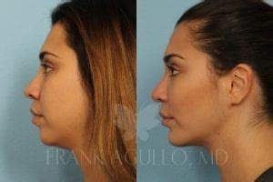 How To Lose Chubby Cheeks Frank Agullo MD