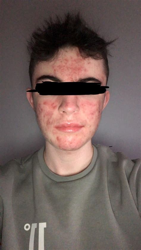 110 Days On Accutane 30mg A Day For 3 Months And For The Past Two Weeks It’s Been Upped To 40mg