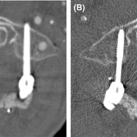 Example Of Gertzbein And Robbins Grade A Screw Placement Download Scientific Diagram