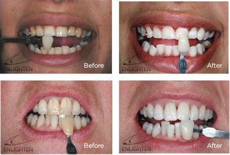 Whitening Handsworth Dental Care