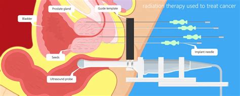 Brachytherapy Cancer At MediTours India We Stand As A Distinguished