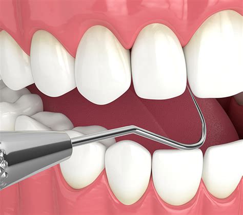 Interactive Periodontal Probing Miami Fl South Florida Dentistry