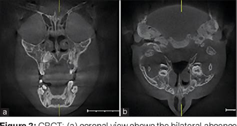 PDF Aplasia And Hypoplasia Of The Maxillary Sinus A Case Series