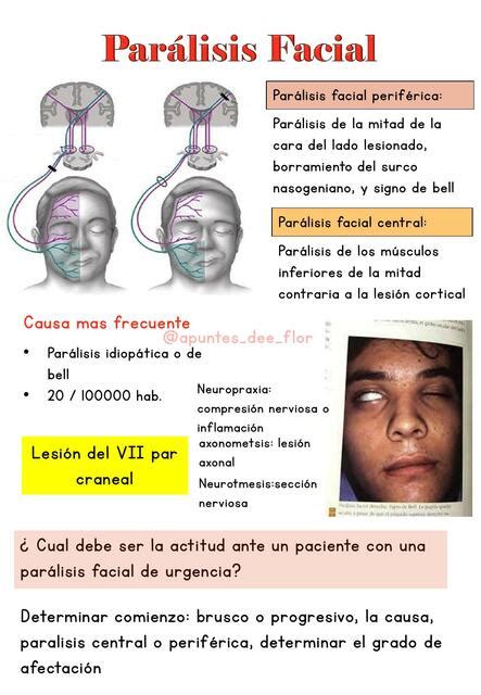 Parálisis Facial Apuntes de Flor uDocz