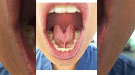 Tongue Tie Severity Grades Tongue Range Of Motion Ratio Youtube