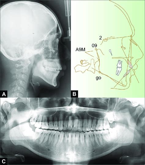 A To C A Pretreatment Lateral Cephalogram B Panoramic Radiograph