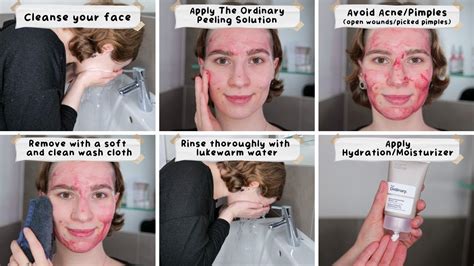 Can I Use The Ordinary Peeling Solution On Acne Youtube