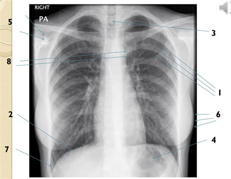 Normal Chest Radiograph Anatomy Diagram Quizlet