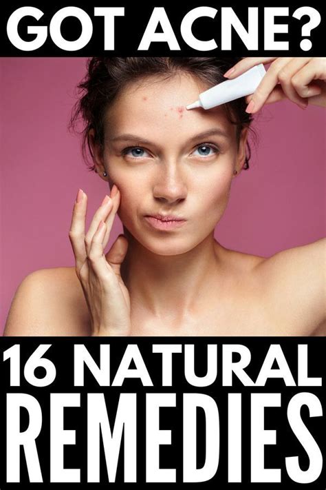 How To Get Rid Of Acne Overnight 12 Remedies That Work How To Get Rid Of Pimples How To Get