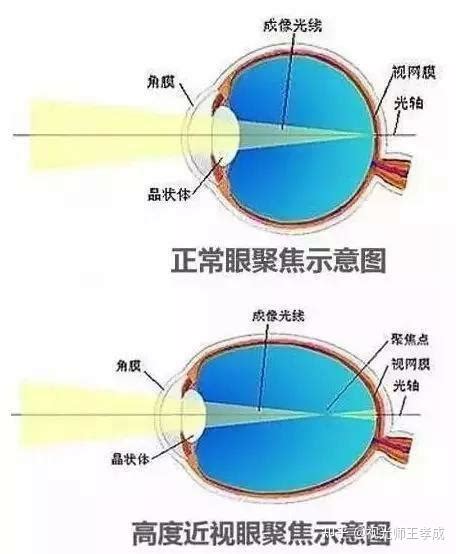 裸眼视力与近视度数的关系 知乎